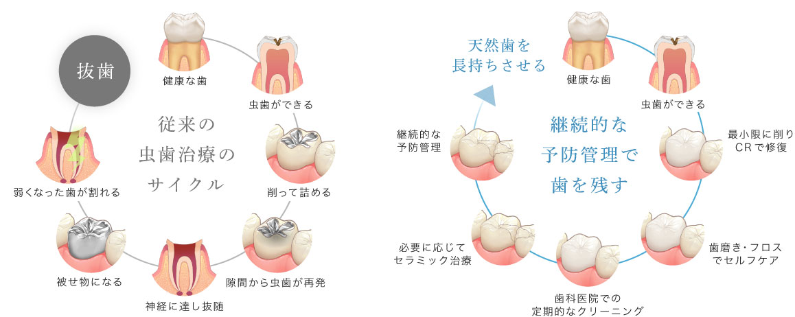 従来の虫歯治療のサイクル 継続的な予防管理で歯を残す